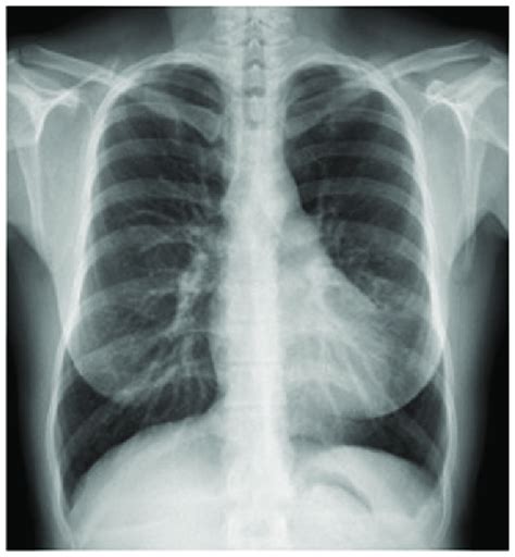 can chest xray show asthma|Asthma (summary) .
